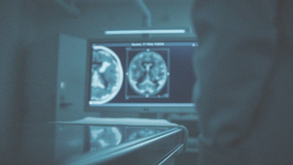 Jakie są długofalowe konsekwencje neurologiczne po nadużywaniu alkoholu?